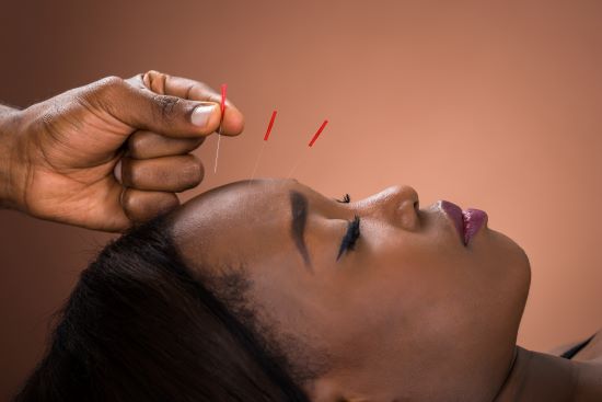 Close-up Of Young African Woman Receiving Acupuncture Treatment